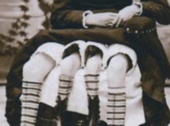 恐怖的美国老照片,竟然有4条腿的双胞胎