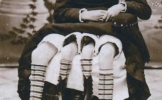 恐怖的美国老照片,竟然有4条腿的双胞胎