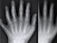 真实经历之56：六指女尸