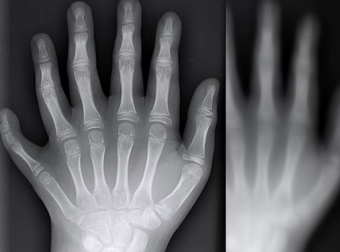 真实经历之56：六指女尸